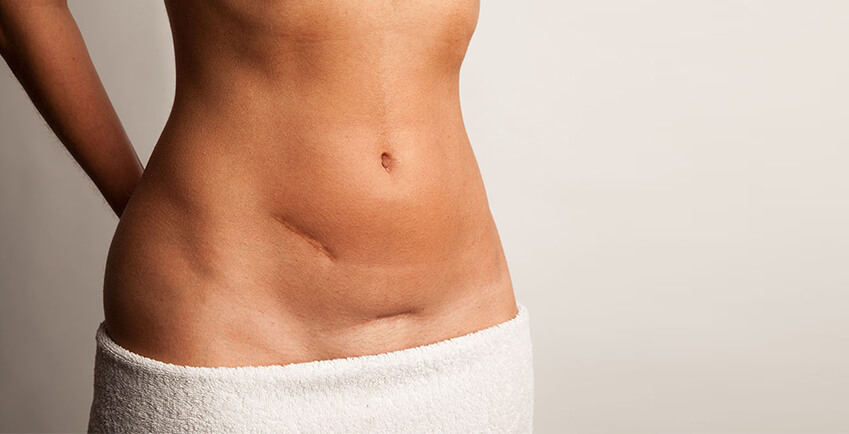 Tummy Tuck Scar  Tummy Tuck Scar Management