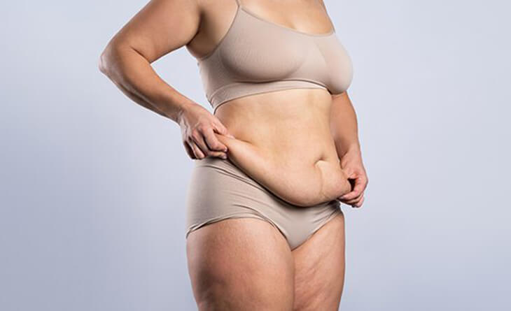 Body Contouring Following Massive Weight Loss – Indian Association Of  Aesthetic Plastic Surgeons