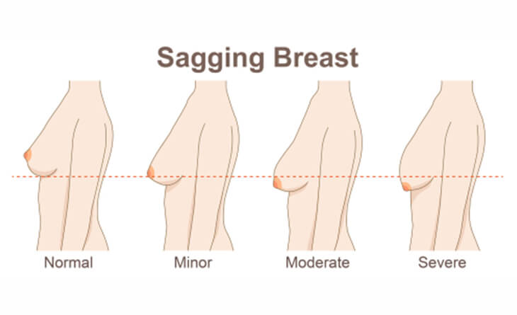 Is It Possible To Lift Saggy Breast ?Breast Lift Procedure - Dr Rajat Gupta