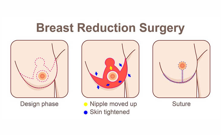 Is It Possible To Lift Saggy Breast ?Breast Lift Procedure - Dr Rajat Gupta