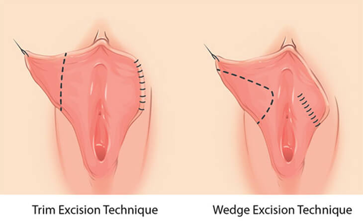 sexual intercourse procedure