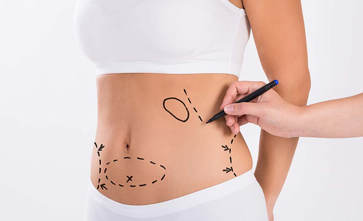 Abdominoplasty / Lipoabdominoplasty – Indian Association Of Aesthetic  Plastic Surgeons