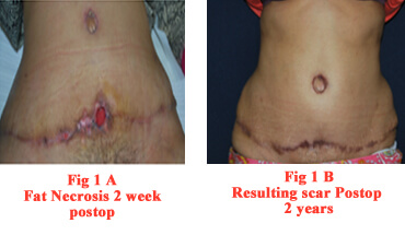 How Is A Tummy Tuck Done Step By Step? Dr Rajat Gupta
