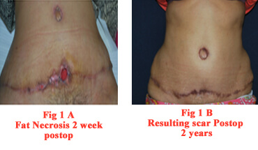 How Fashion Affects Abdominoplasty Scar Placement