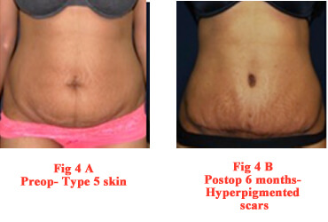 Abdominoplasty Scar – Indian Association Of Aesthetic Plastic Surgeons