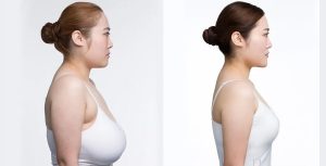 Breast Reduction Can Lighten Your Life - IAAPS