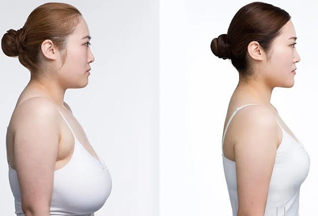Breast Reduction Can Lighten Your Life - IAAPS