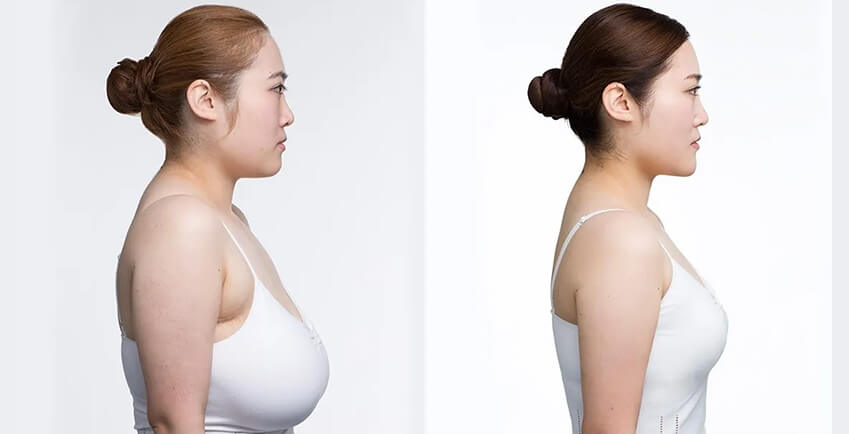 Breast Reduction Can Lighten Your Life - IAAPS