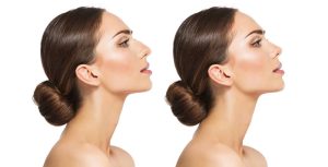 rhinoplasty can and cannot do