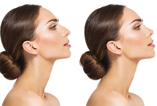 rhinoplasty can and cannot do