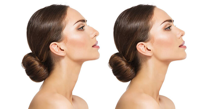 rhinoplasty can and cannot do