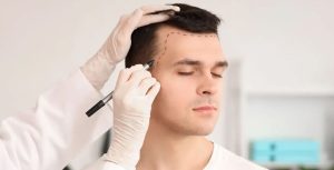 Beyond the Hairline- Complications of Hair Transplantation and Their Prevention