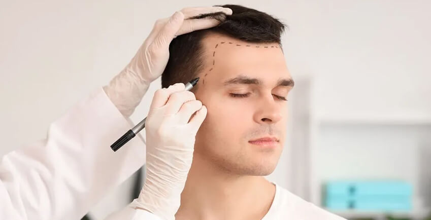 Beyond the Hairline- Complications of Hair Transplantation and Their Prevention