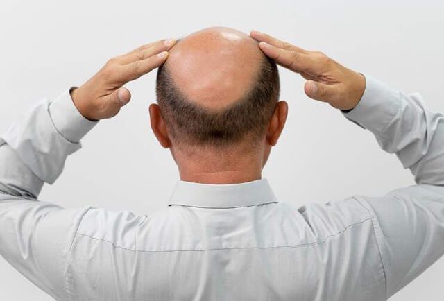 What Can Go Wrong in a Hair Transplant